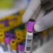 Tubercolosi, verso test sangue ultra-sensibile per diagnosi infezione latente o iniziale