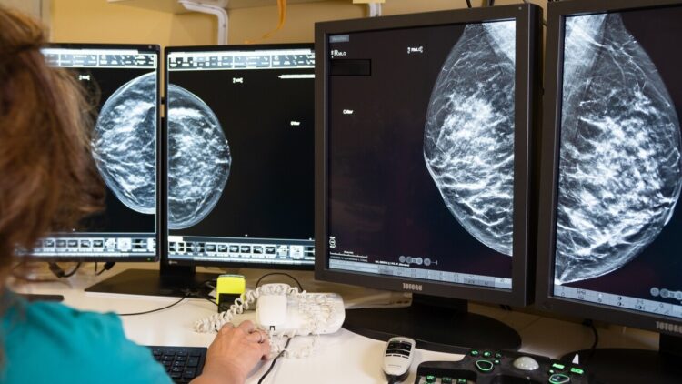 Tumore al seno, con la diagnosi precoce la sopravvivenza a 10 anni supera il 90%