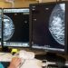 Tumore al seno, con la diagnosi precoce la sopravvivenza a 10 anni supera il 90%